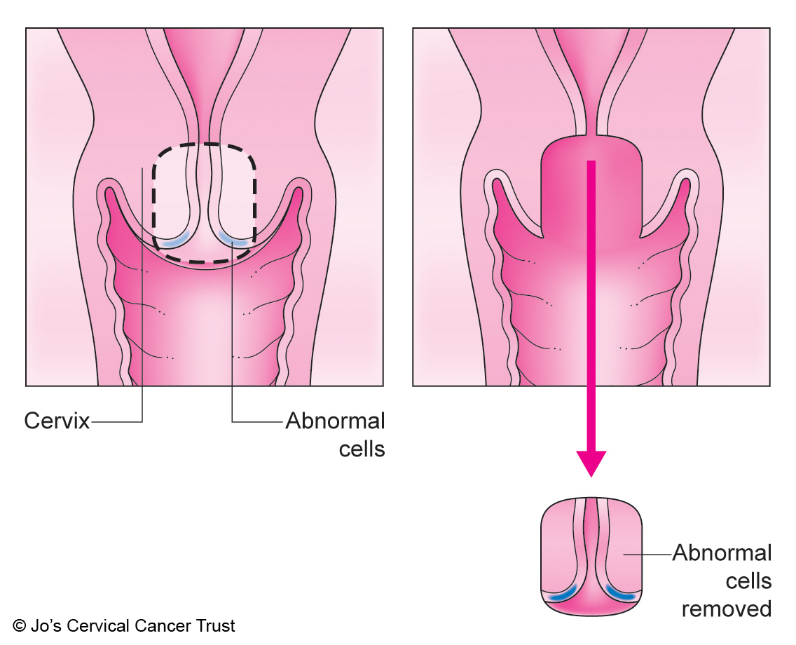 diagram of cone biopsy from Jo's Cervical Cancer Trust