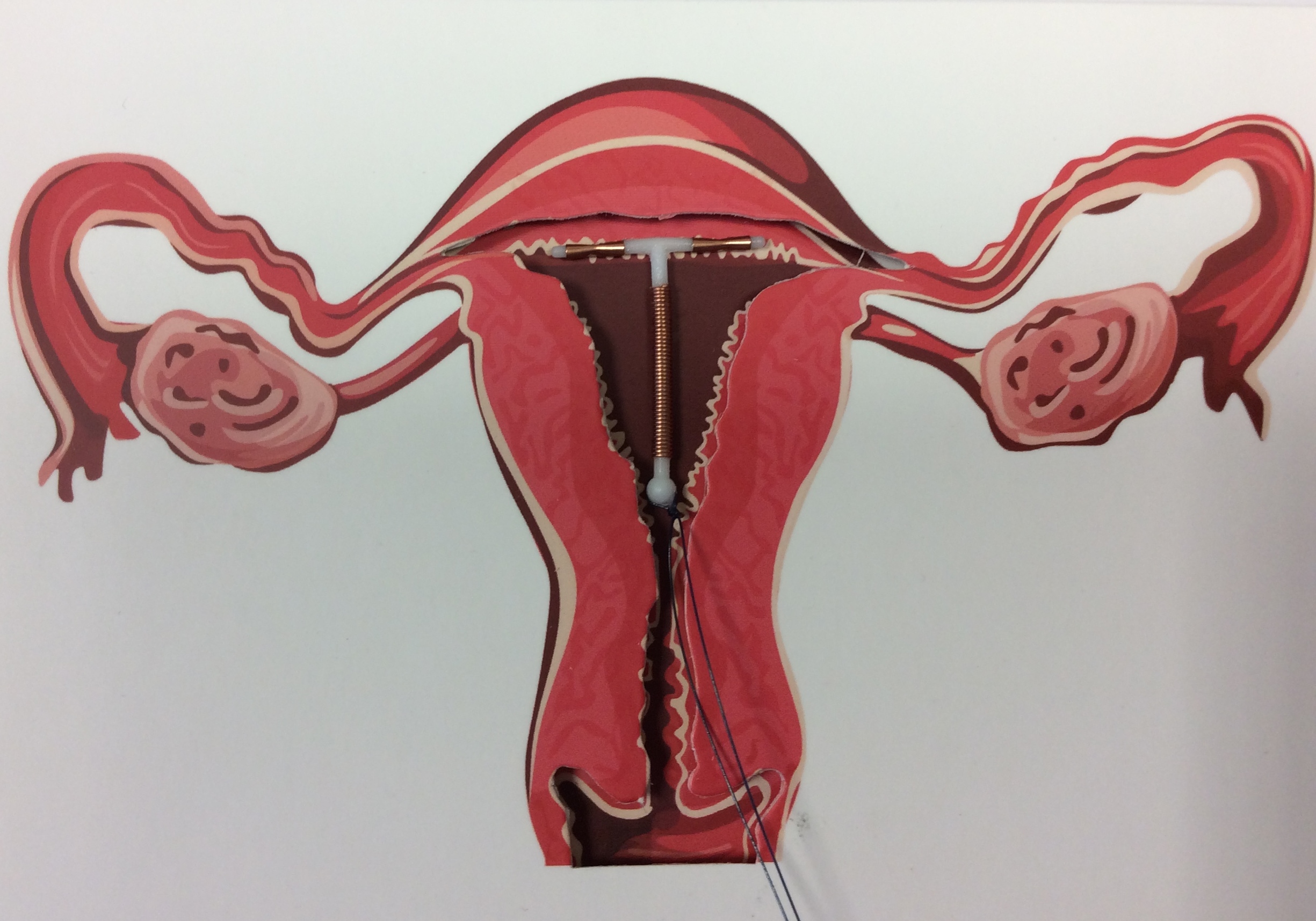 Intrauterine Device, IUD, coil in womb diagram