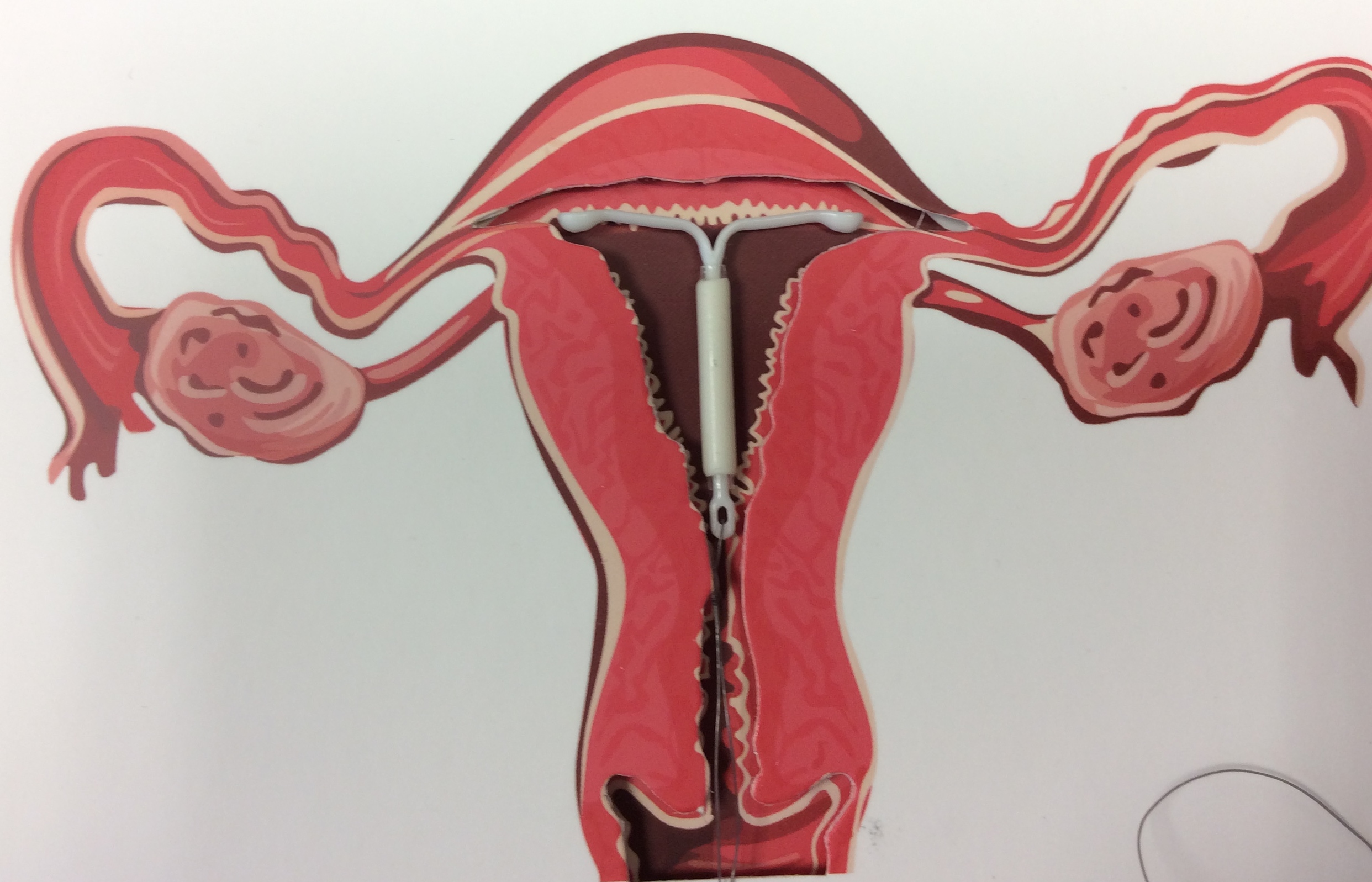 Intrauterine system, IUS, Coil, in womb diagram