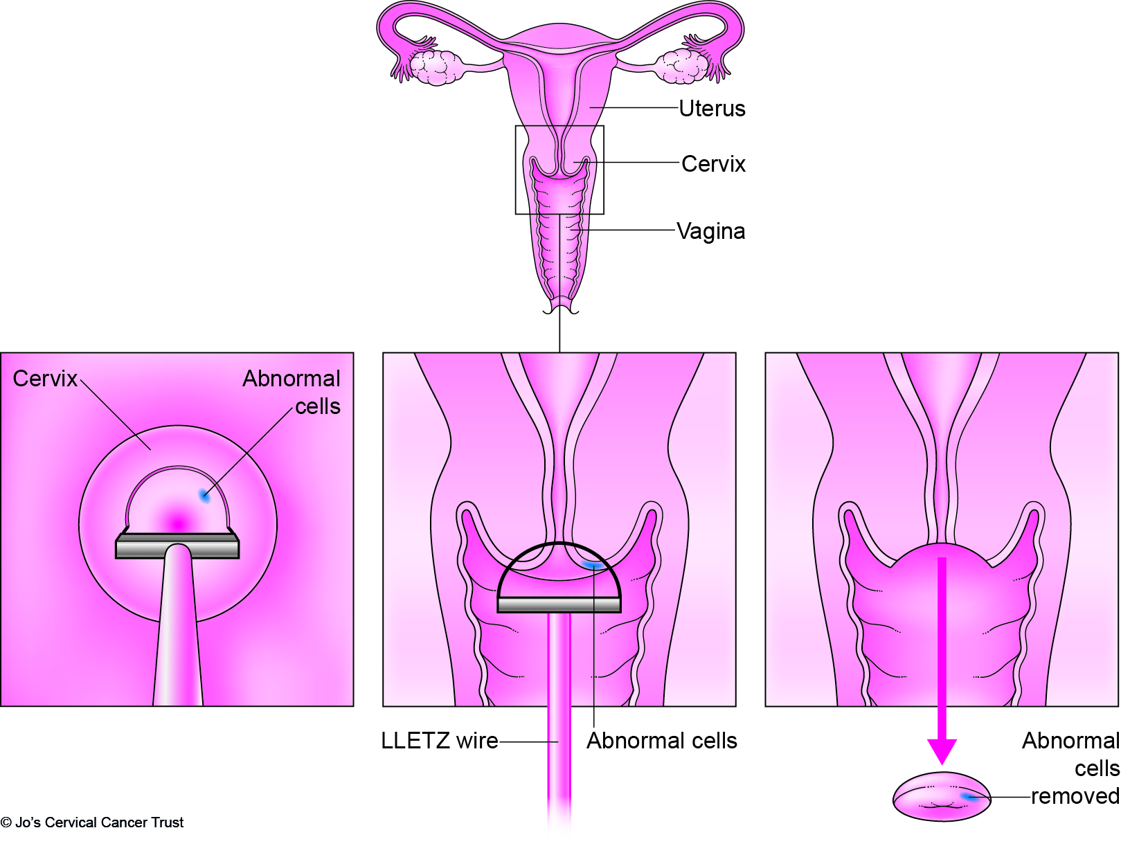 Diagram of Loop diathermy from Jo's Cervical Cancer Trust