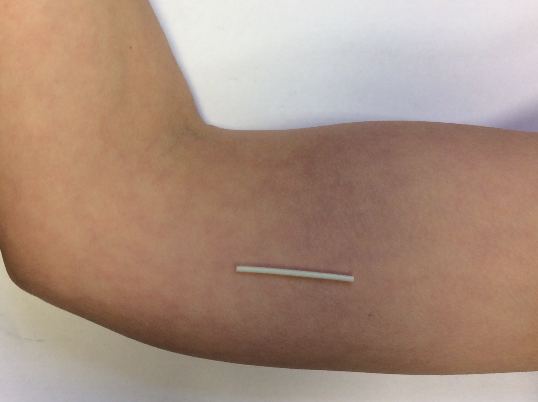 picture of and arm with a contraceptive implant